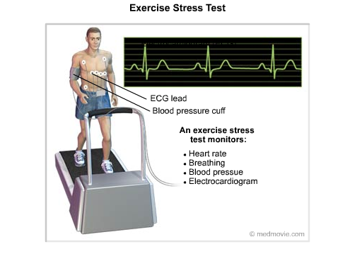 Exercise Stress Test Mets Chart