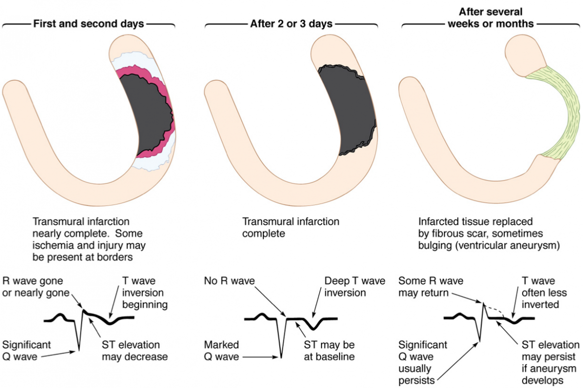 pathological q wave pathological q wave