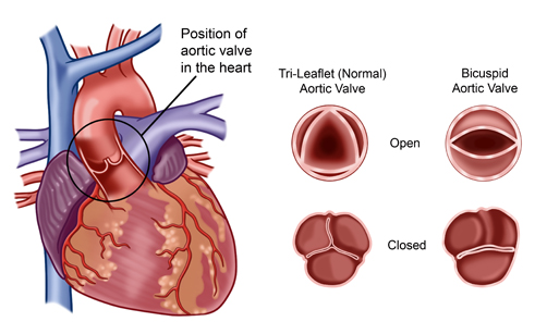Bicuspid Aortic Valve Disease Cardiac Health