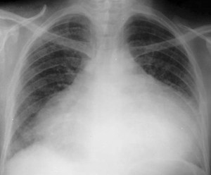 Cardiac-Tamponade-X-ray