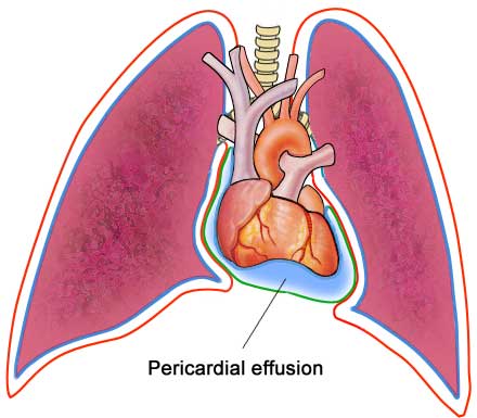 Pericardial_Effusion