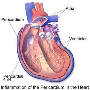 Pericarditis