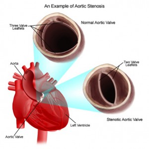 an_example_of-aortic_stenosis