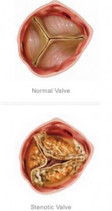 an_example_of-aortic_stenosis2