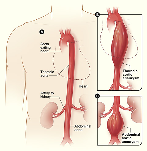 aneurysm_aortic
