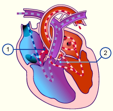 Cardiac Defects with a Left to Right Shunt (Acyanotic) | Cardiac Health
