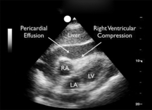 cardiactamponae