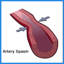 coronaryarteryspasm
