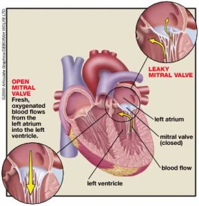 mitral_valve_prolapse-289x300