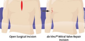 mitral_valve_repair_comparison_395x190