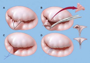 mitralvalverepair1-3col