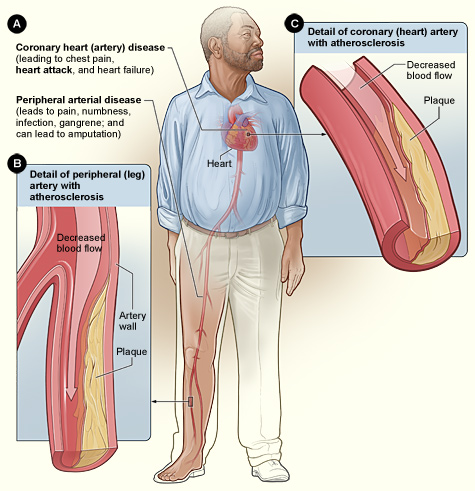 smoking_heartdisease