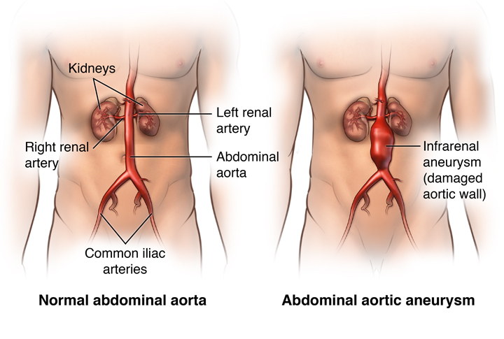 Abdominal Aortic Aneurysms | Cardiac Health