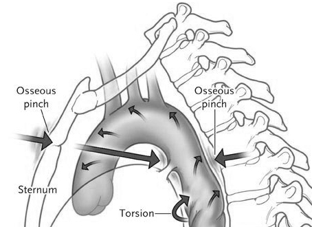 Aortic-Injury-Mechanism