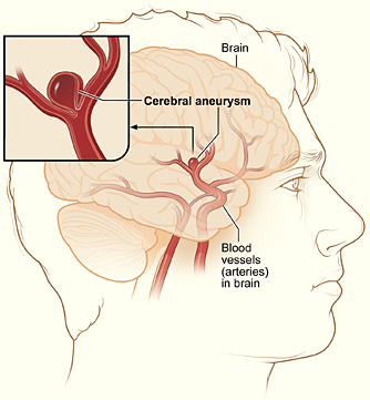 Cerebral_aneurysm