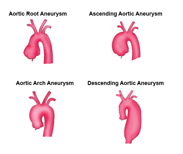 thoracic aneurysms