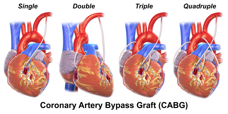 Diabetes, Multivessel CAD, and LV Dysfunction? Registry Analysis Gives CABG  the Edge Over PCI