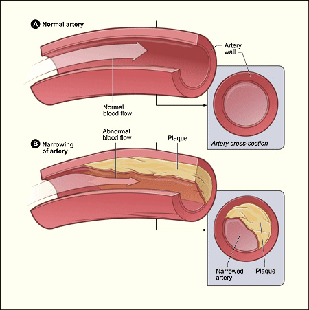 CoronaryArteryDisease