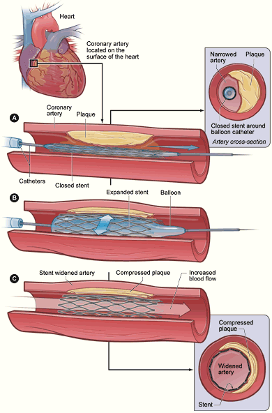 PTCA_stent_NIH