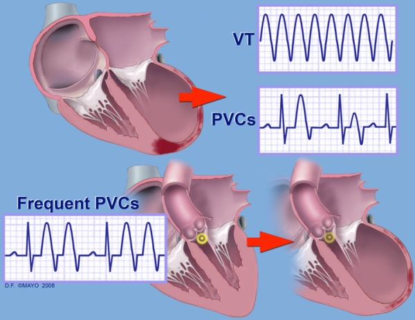 can low blood pressure trigger pvcs