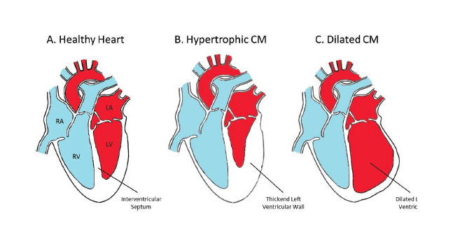 Cardiomyopathy - Cardiac Health

