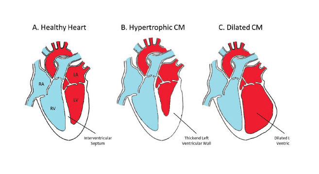 Cardiomyopathy - Cardiac Health