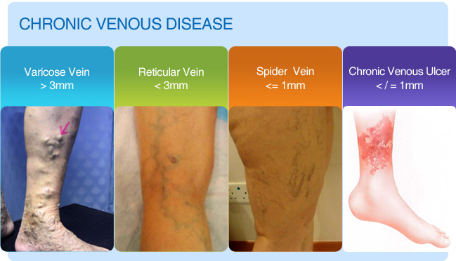 Chronic Venous Insufficiency & Varicose Veins - Elite Cardiovascular Group